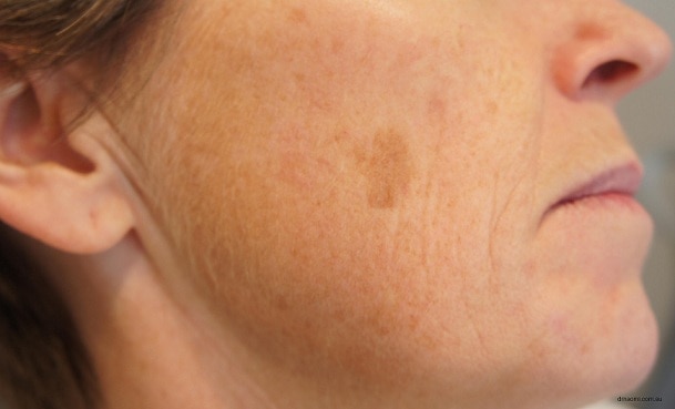 Brown & Age Spot Removal in Scottsdale & Paradise Valley